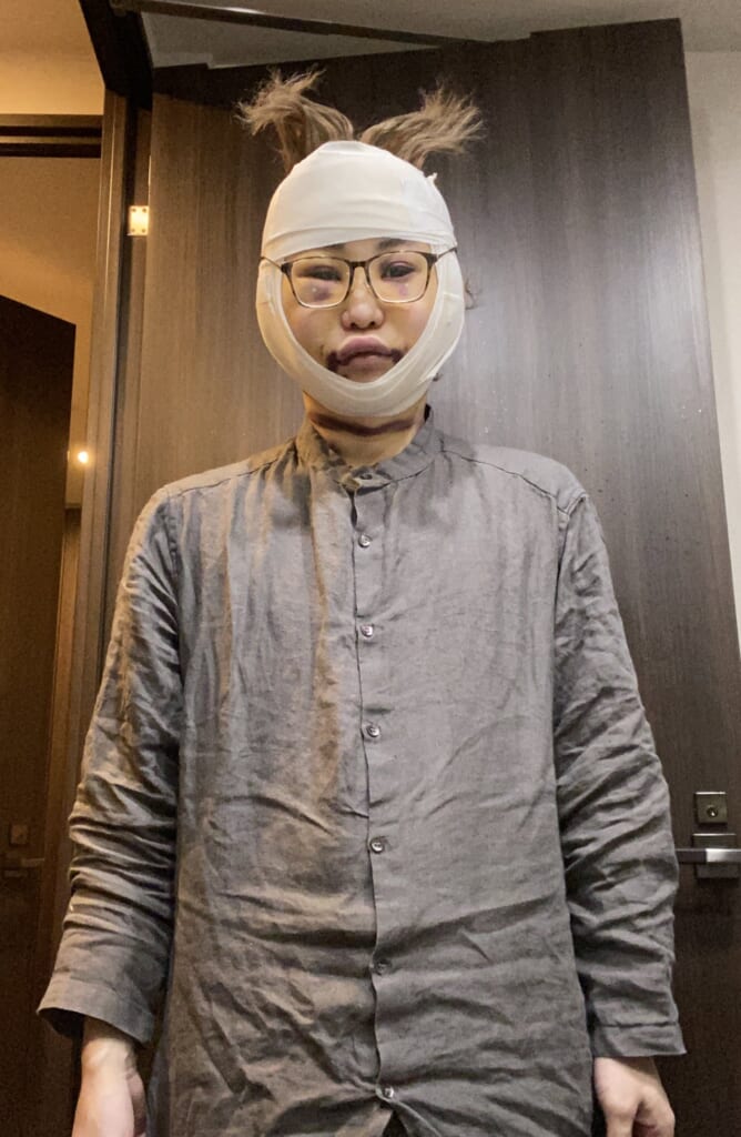 粟谷麦さんダウンタイム写真